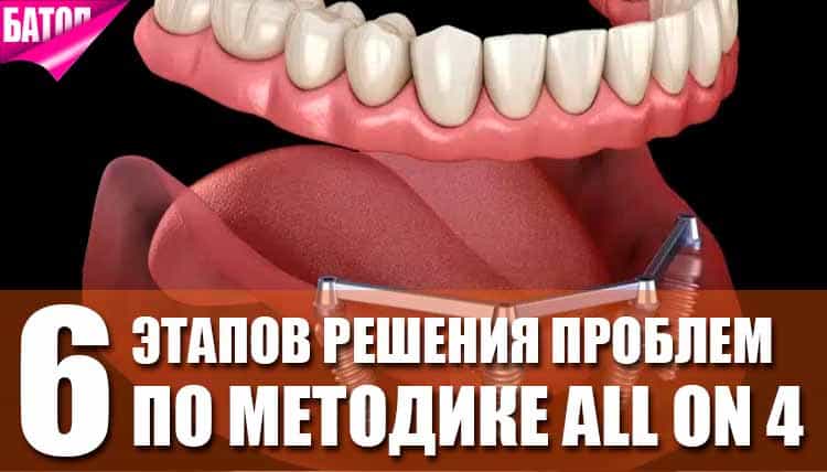 All-on-4: быстрое решение проблемы полной адентии за один визит к стоматологу All-on-4: быстрое решение проблемы полной адентии за один визит к стоматологу